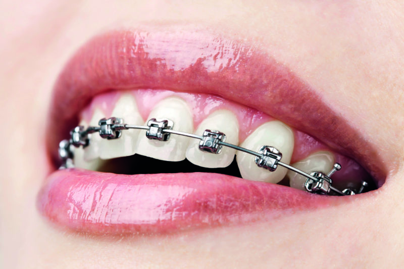 Traditional Braces